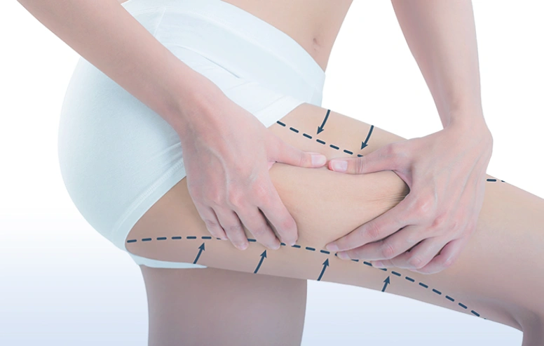 Κυτταρίτιδα Header Image